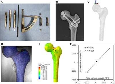 Partial femoral head replacement: a new innovative hip-preserving approach for treating osteonecrosis of the femoral head and its finite element analysis